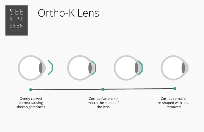 Ortho-K Lens Diagram