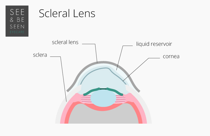 Scleral Lens diagram