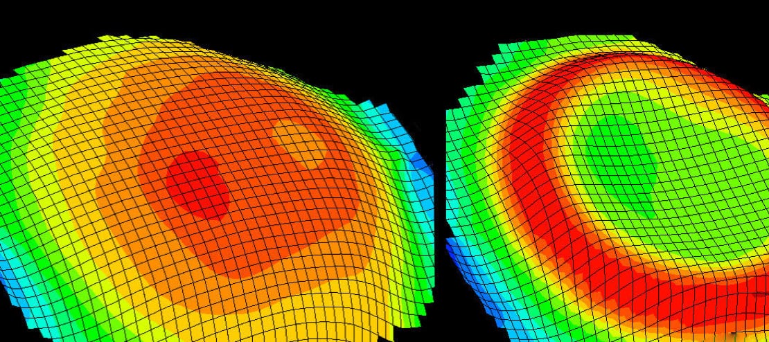 A digital graphic demonstrating an ortho-k lens reshaping the cornea