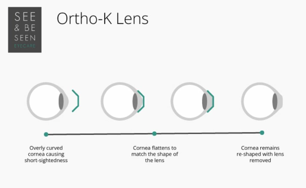 Ortho-K Lens diagram. From left to right: Overly curved cornea causing short-sightedness, cornea flattens to match the shape of the lens, cornea remains re-shaped with lens removed
