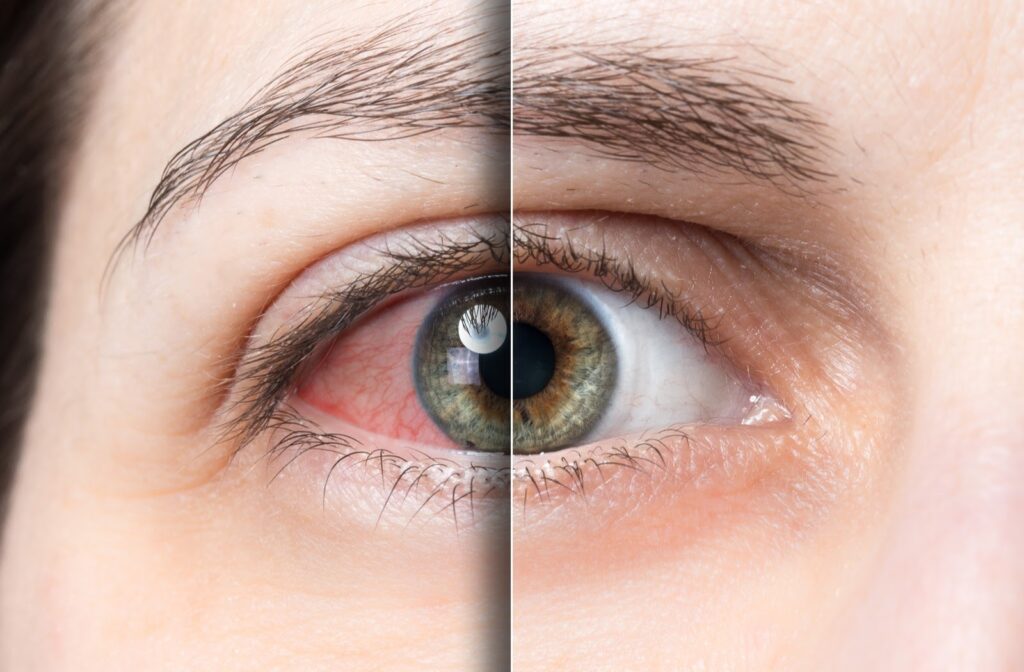 Close up of eye on left with dry eye and on right with clear healthy eyes