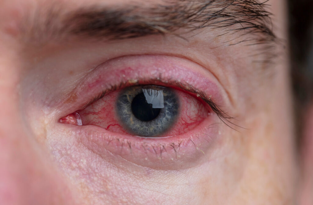 Man with red eyes caused due to Blepharitis