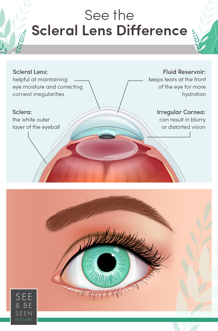 What Is A Scleral Contact Lens Toronto On See And Be Seen