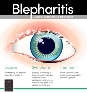 What Is Blepharitis? [Causes, Treatment, & More] | Toronto