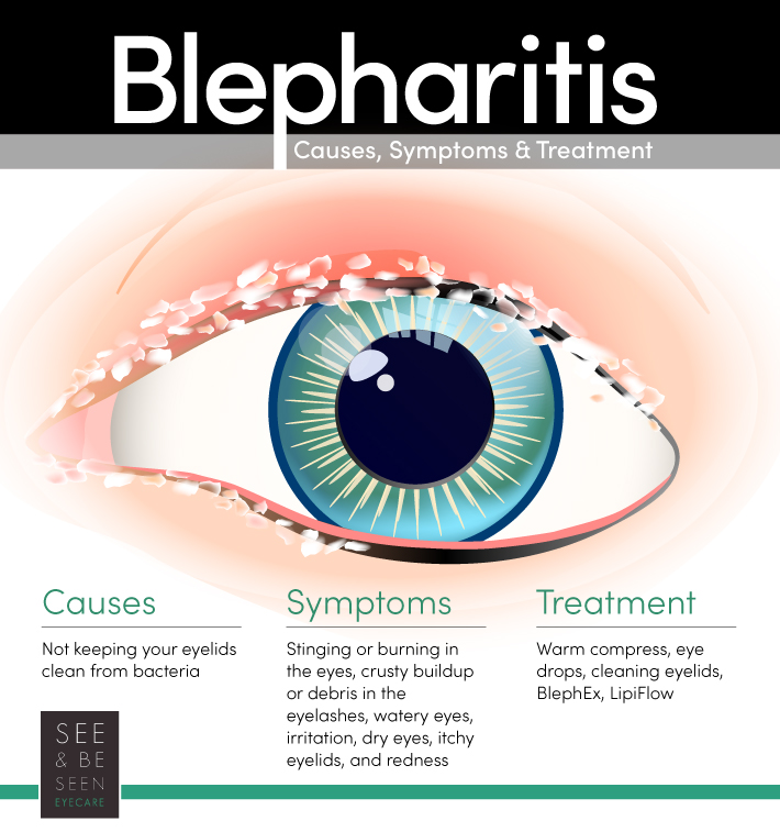 Blepharitis causes, symptoms and treatments