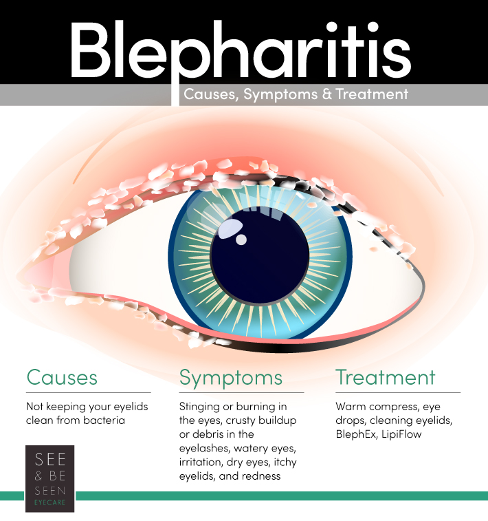 eyelid disease blepharitis