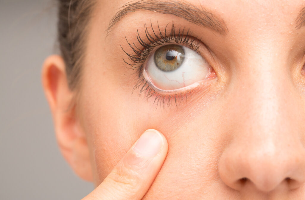 Close up of women opening her eyes with finger as she experiences dry eye