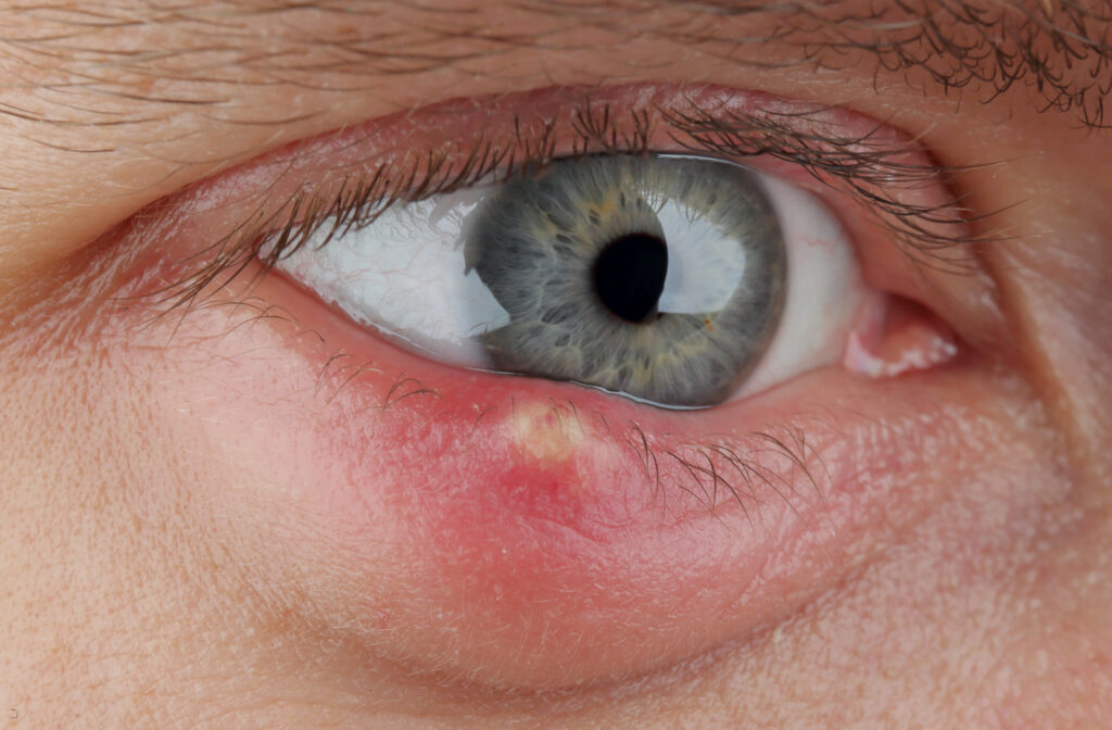 What Is a Stye (Sty) in the Eye?