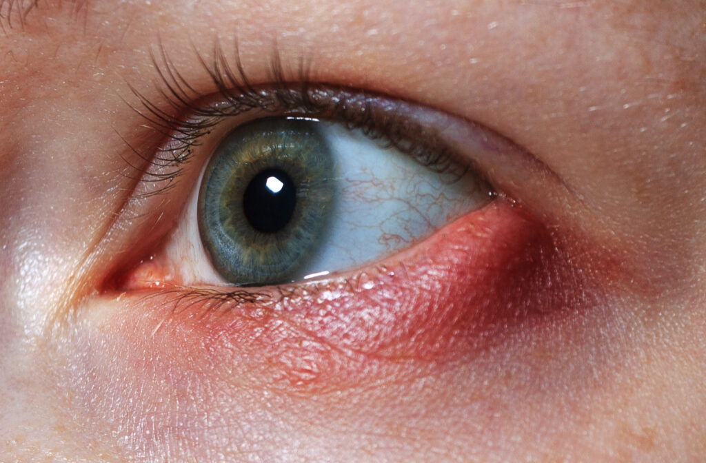 Close up of eye stye on women's eyes