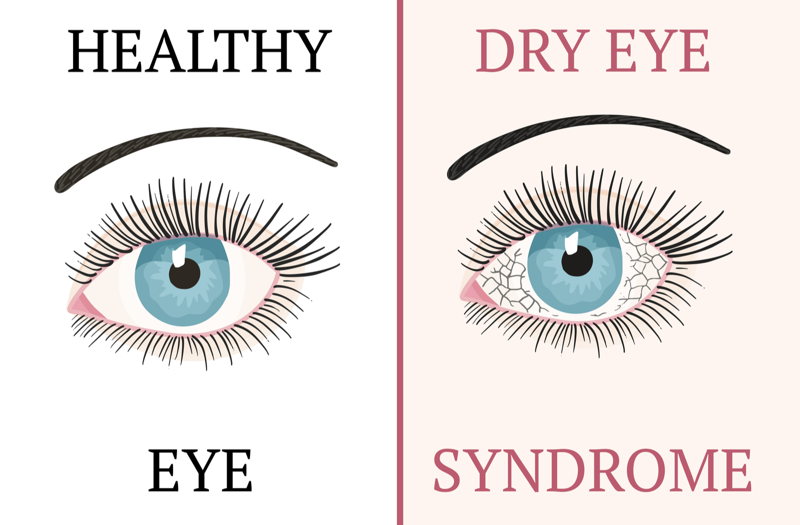 Healthy eye on the left compared with dry eye syndrome on right