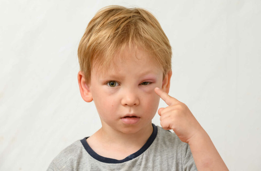 A small boy pointing at his swollen eyelid.