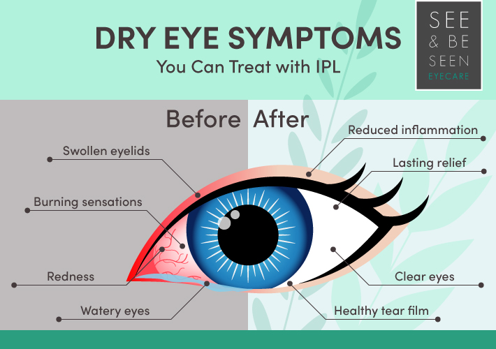 A labelled image of an eye to highlight all before treatment symptoms of dry eye and after IPL treatment relief condition of the eye.