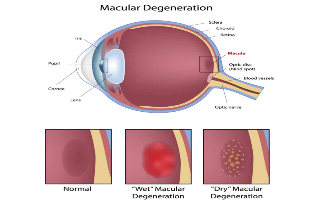 An illustration of what happens in wet and dry macular degeneration.
