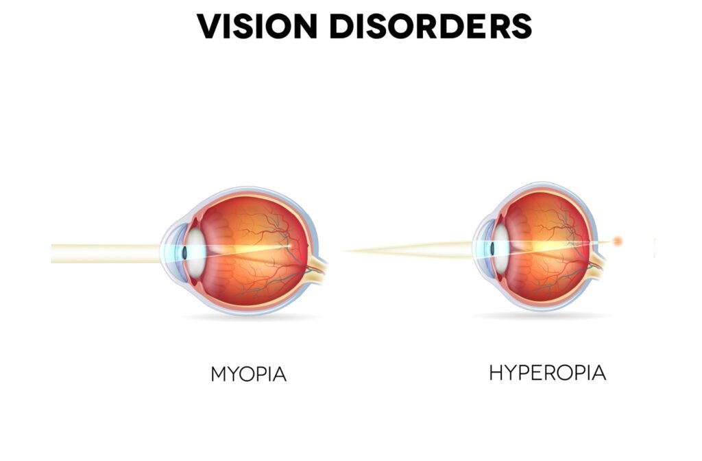 Myopia vs Hyperopia explained in a visual illustration