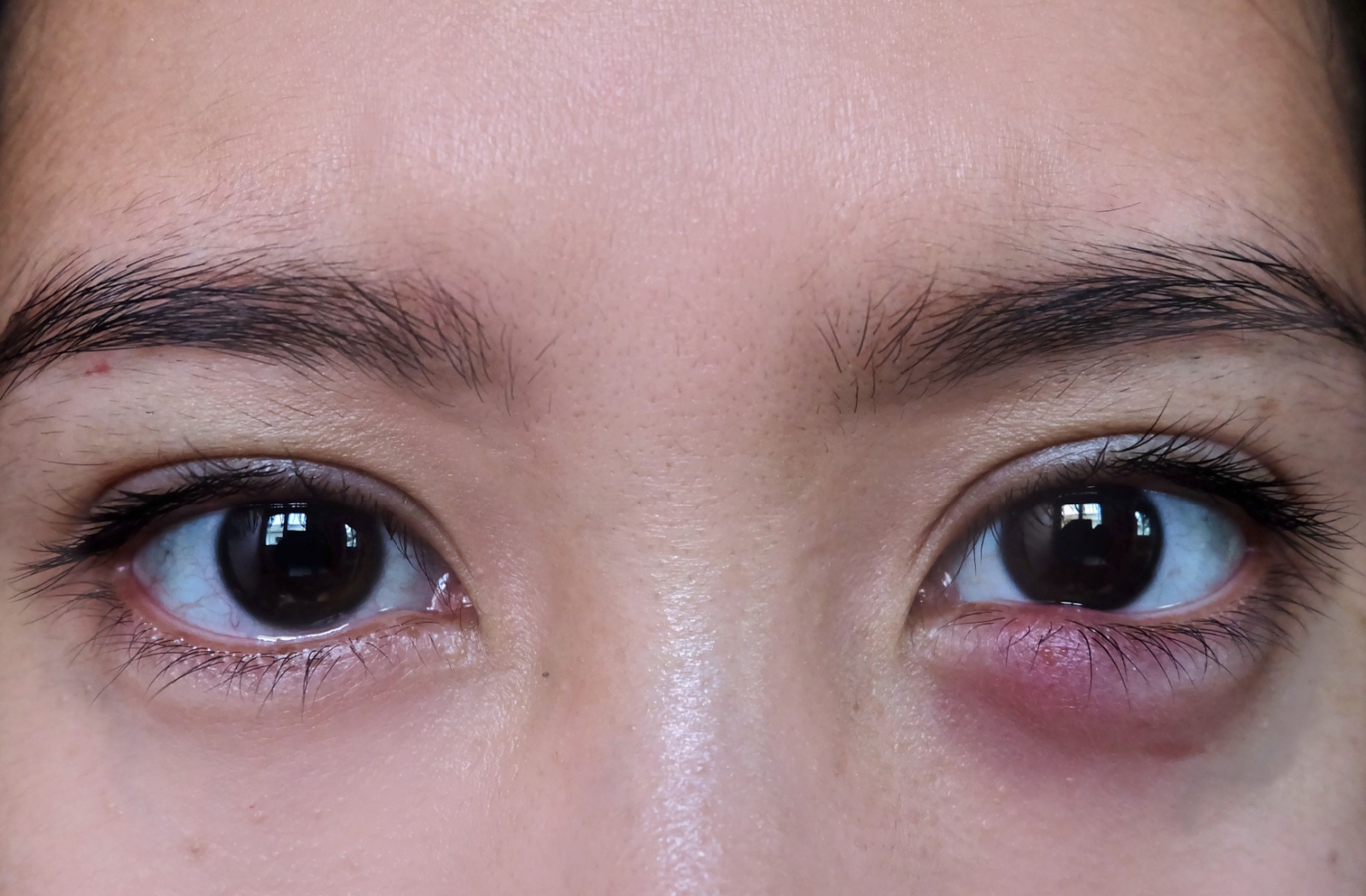 Closeup of a person’s brown eyes, with a red and irritated stye on the lower eyelid of their right eye