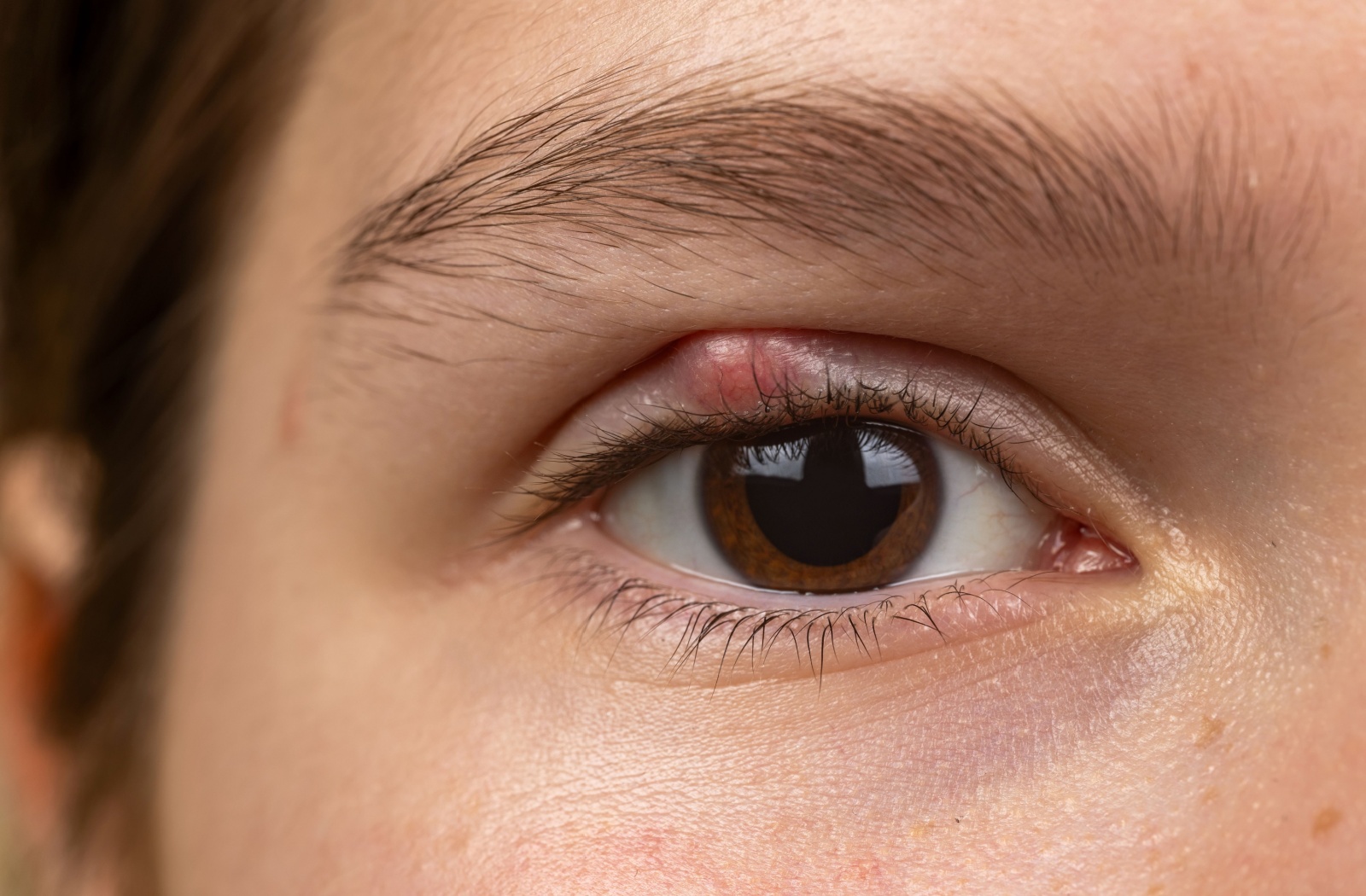 A close-up image of a person's right eye with a stye on their upper eyelid.