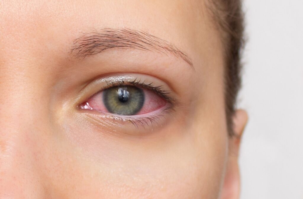 Close-up of an irritated, red eye showing common dry eye symptoms such as redness and inflammation.