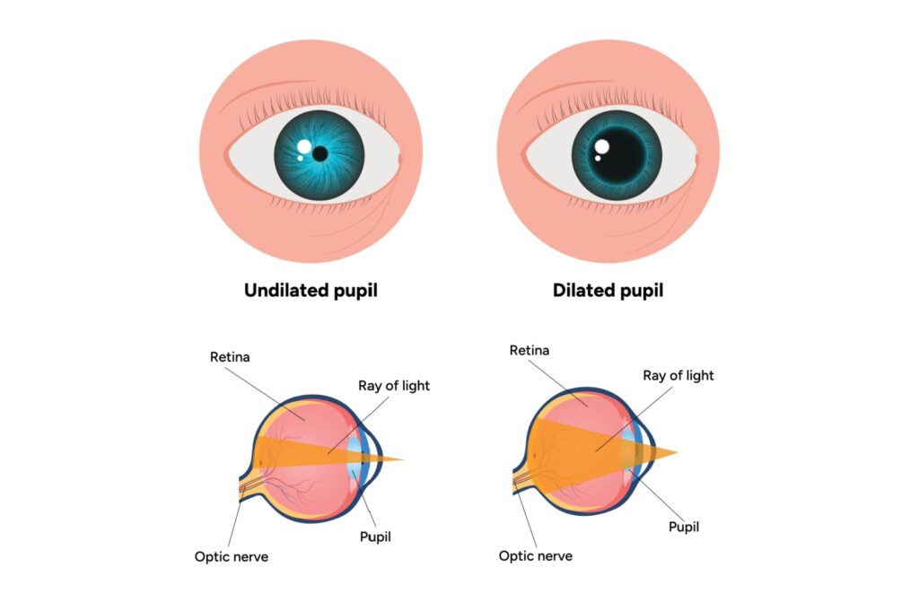 Illustrated comparison of an undilated and dilated pupil with diagrams showing how light enters the eye and reaches the retina.