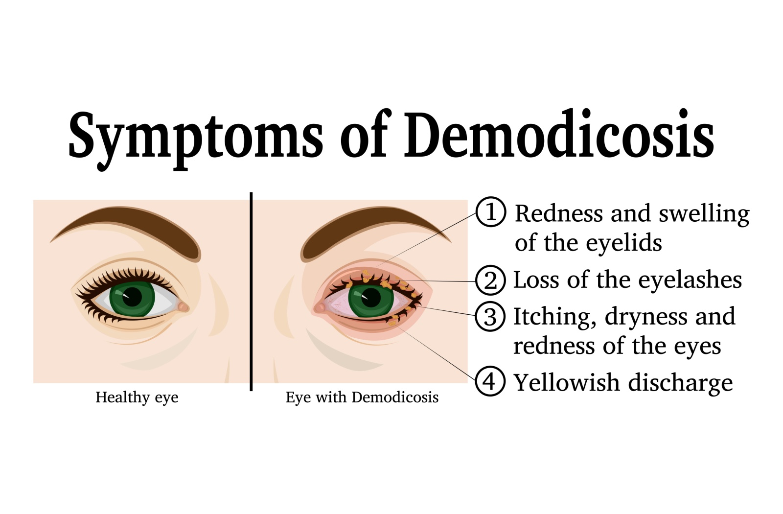 Side-by-side comparison illustration showing healthy eye versus eye with Demodicosis displaying symptoms including eyelid redness and swelling, eyelash loss, itching and dryness, and yellowish discharge.