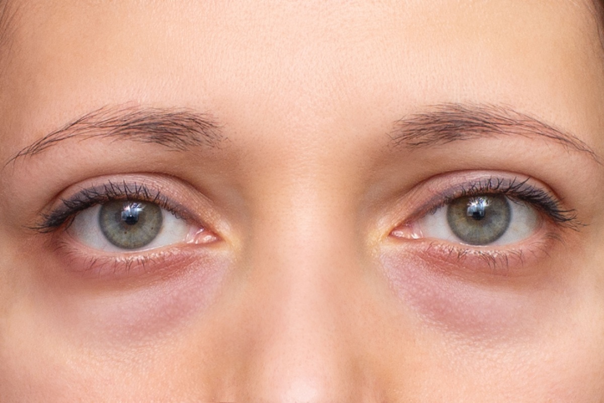 Up close image of a woman showing dark under eye circles.