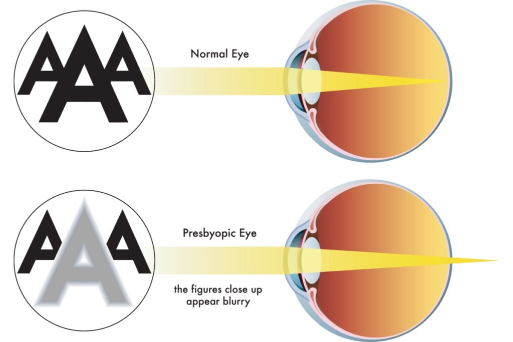 Normal eye vs presbyopic eye focus diagram.